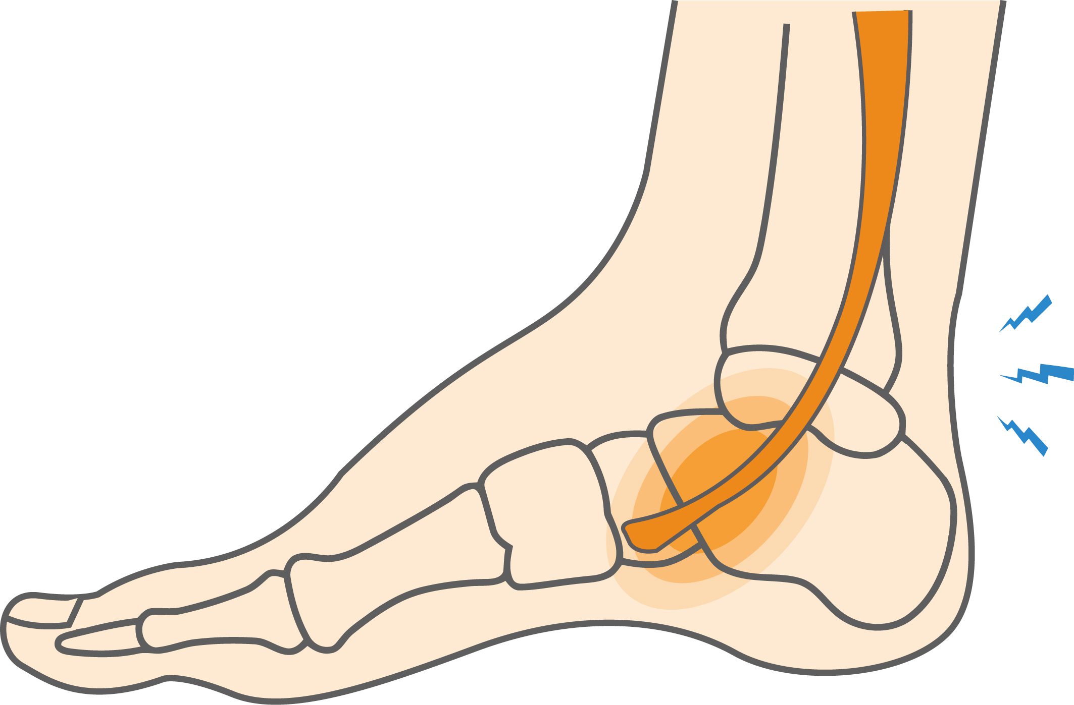 Posterior tibialis tendon tendinopathy pain on inner ankle and arch physiotherapy treatment