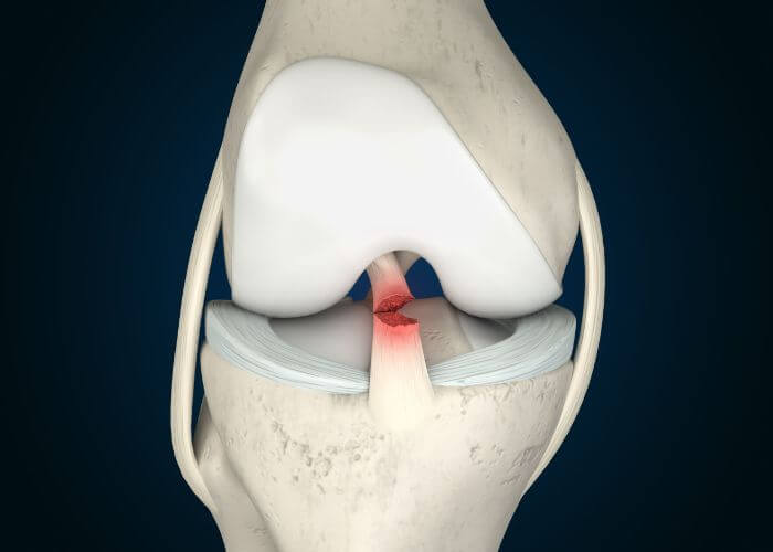 ACL tear surgery vs conservative physiotherapy treatment in Singapore